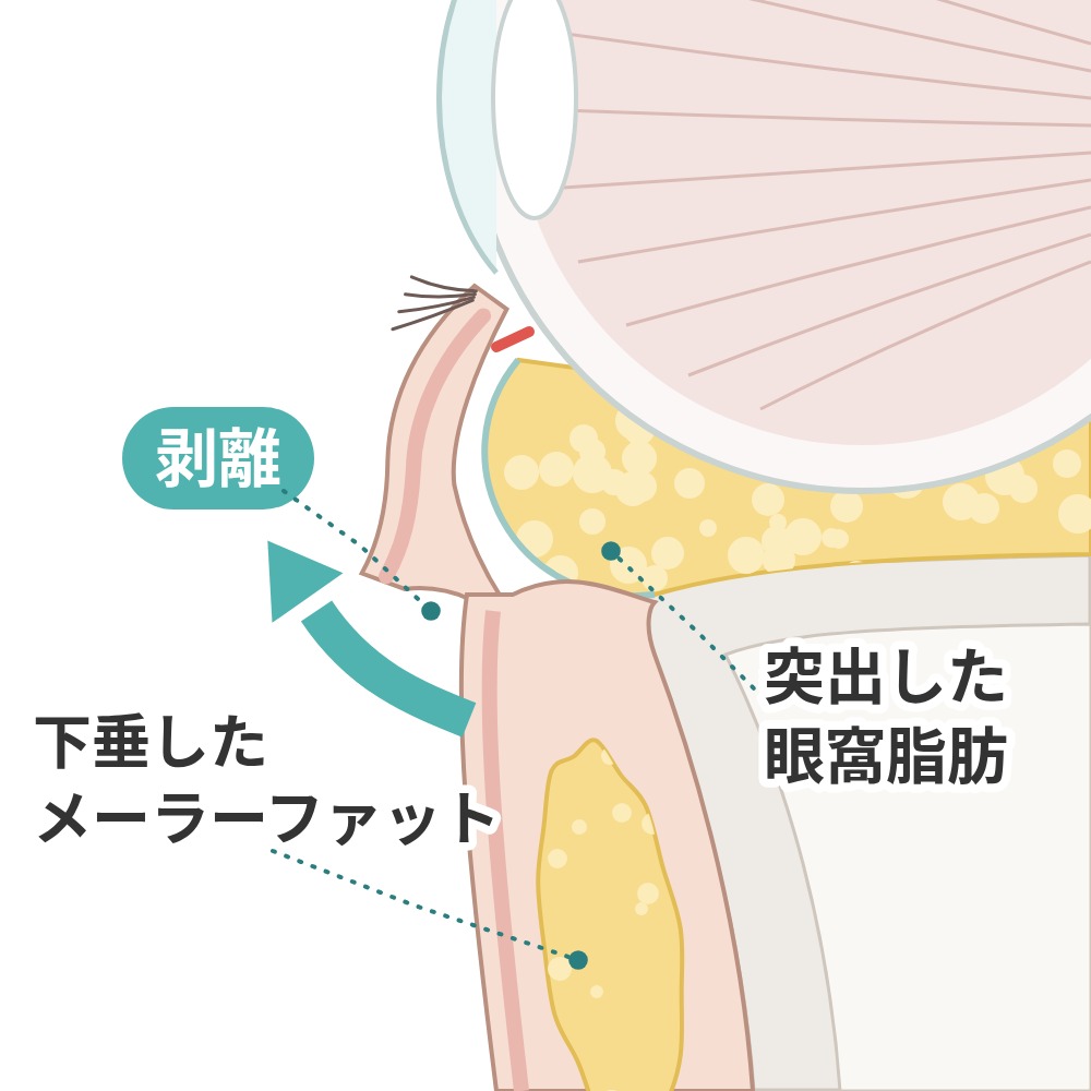 剥離：下垂したメーラーファットと突出した眼窩脂肪
