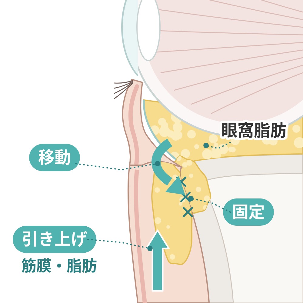 引き上げ・固定の断面図：筋膜・脂肪を引き上げて固定