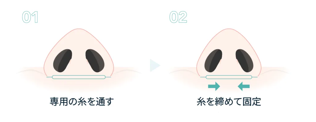 切らない小鼻縮小で糸を通して締める仕組みの図（Leap beauty clinic）