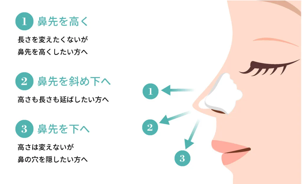 鼻中隔延長で鼻先を高く・斜め下へ・下へ延ばす方向の図(Leap beauty clinic)