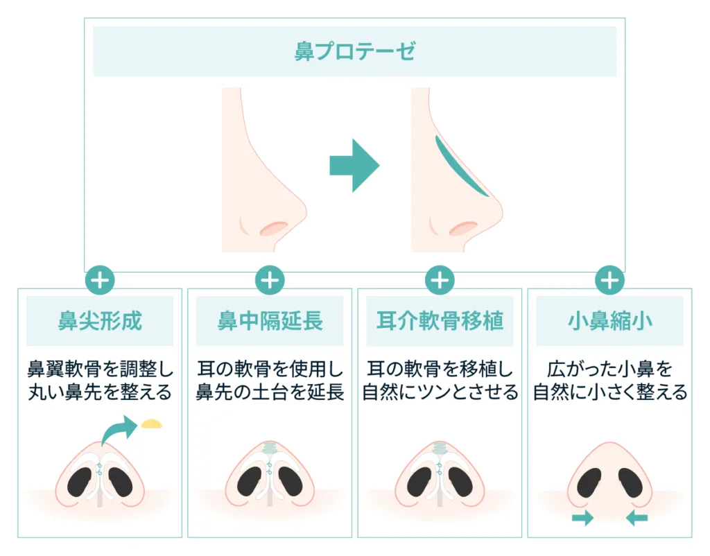 鼻プロテーゼと組み合わせる鼻整形の図（Leap beauty clinic）