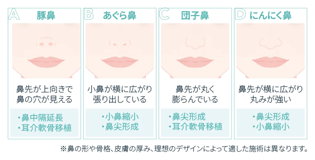 鼻先の形のタイプと候補になる施術の図(Leap beauty clinic)