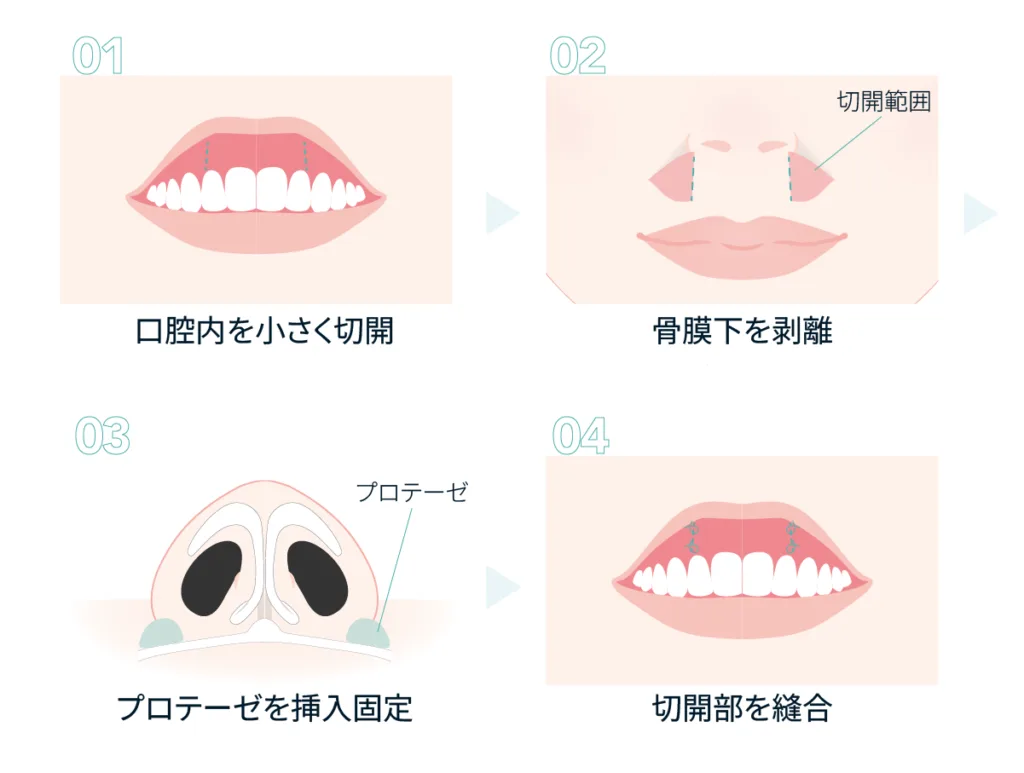 貴族手術(鼻翼基部プロテーゼ)の手順の図(Leap beauty clinic)