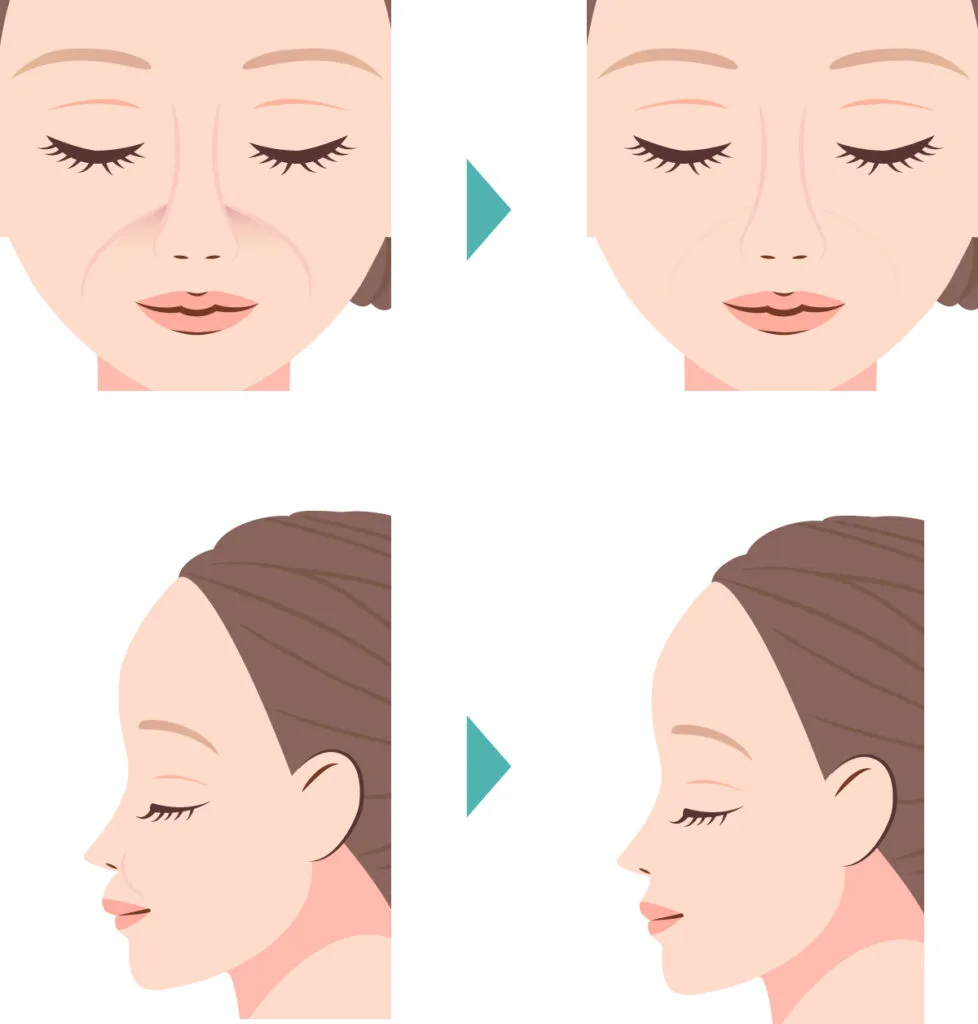 小鼻の付け根の凹みを補う前後の見え方のイラスト(Leap beauty clinic)