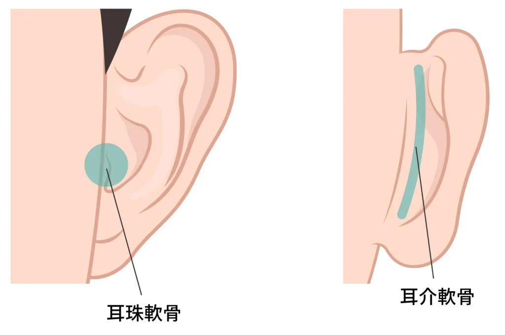 耳珠軟骨と耳介軟骨を採る位置の図(Leap beauty clinic)