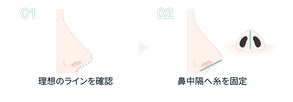 切らない鼻中隔延長で鼻中隔へ糸を固定する仕組みの図(Leap beauty clinic)