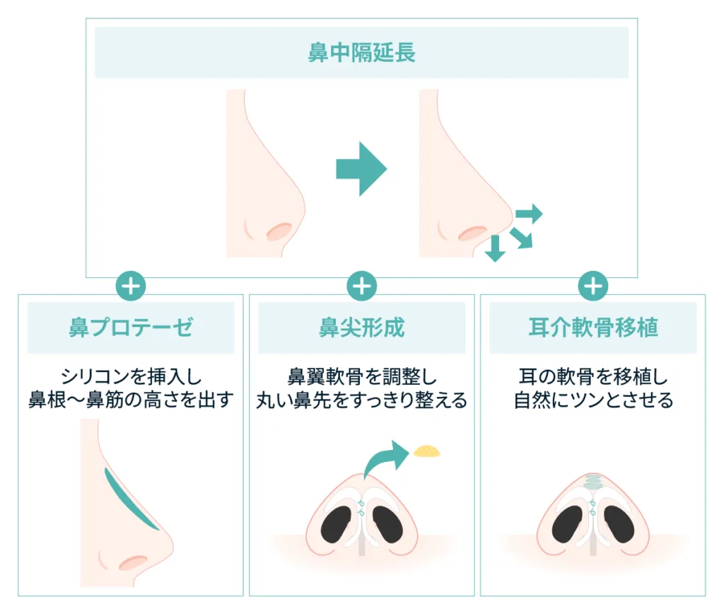 鼻中隔延長と鼻プロテーゼ・鼻尖形成・耳介軟骨移植の役割の図(Leap beauty clinic)