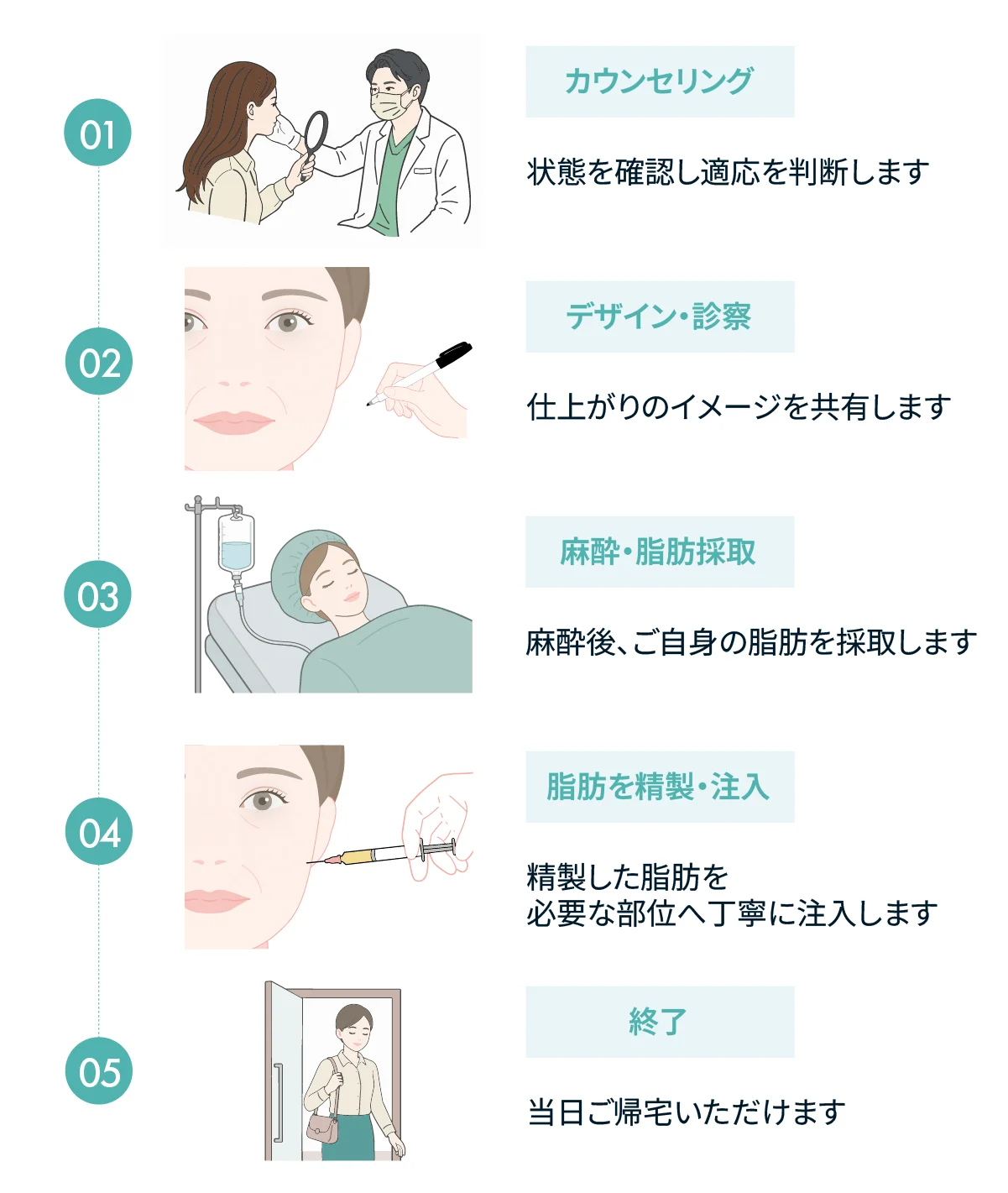 脂肪注入の流れの図。カウンセリング、デザイン・診察、麻酔・脂肪採取、脂肪を精製・注入、当日帰宅の5段階(Leap beauty clinic)