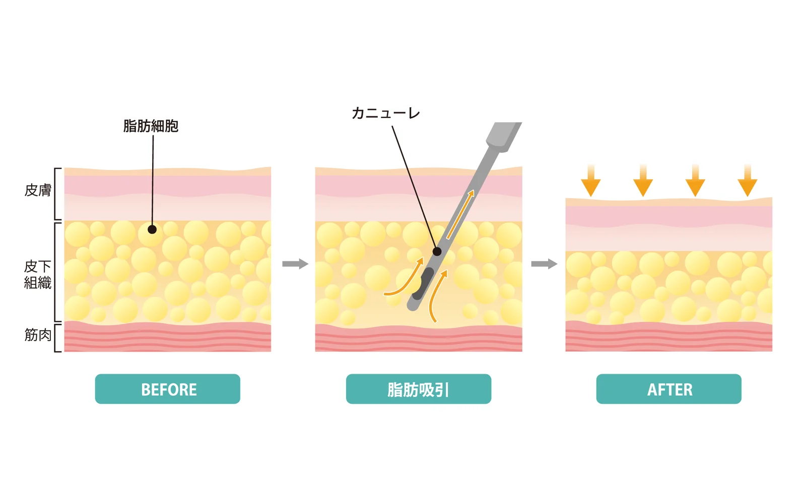 皮膚の下の脂肪細胞をカニューレで吸引し、吸引後も脂肪の層が残る様子をBEFORE・脂肪吸引・AFTERで示した図（Leap beauty clinic）