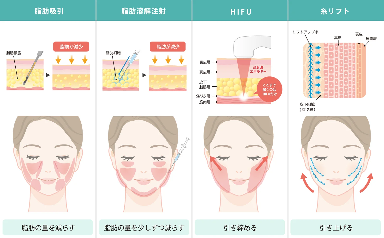 脂肪吸引・脂肪溶解注射・HIFU・糸リフトを並べ、脂肪の量を減らす・引き締める・引き上げるという働きの違いを示した図(Leap beauty clinic)