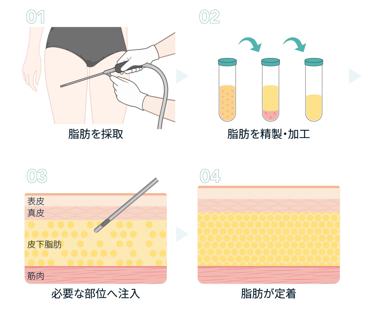 脂肪を採取し、精製・加工して必要な部位の皮下脂肪へ注入し、脂肪が定着するまでの4段階を示した脂肪注入の仕組みの図(Leap beauty clinic)