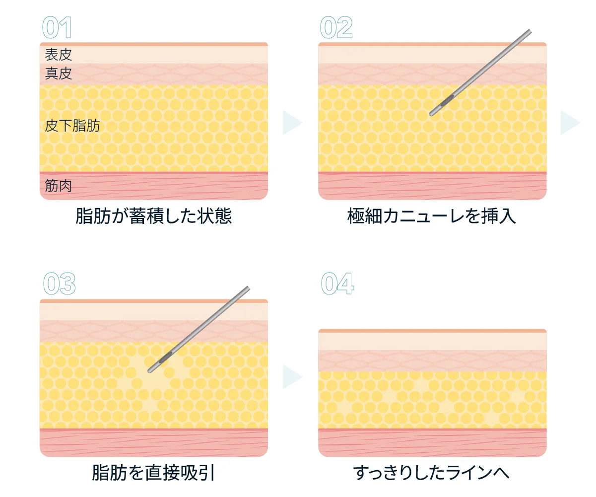 皮下脂肪に極細カニューレを挿入し、脂肪を直接吸引してすっきりしたラインへ整えるまでの4段階を示した脂肪吸引注射の仕組みの図(Leap beauty clinic)