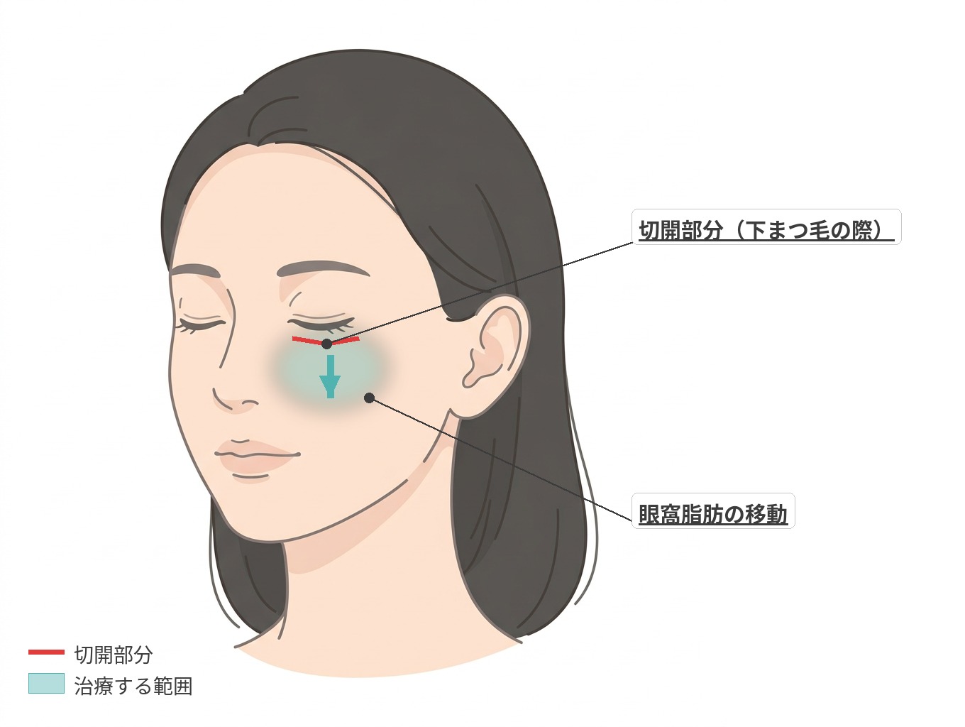 表ハムラ法の切開部分と眼窩脂肪の移動