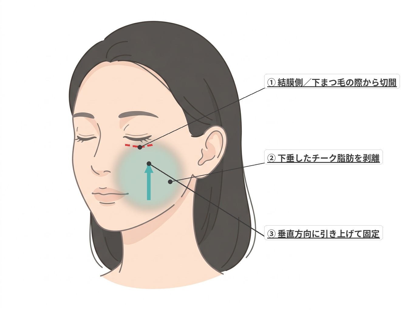 目の下（皮膚または結膜）を切開し、下垂したメーラーファットを上方へ移動して固定する流れ
