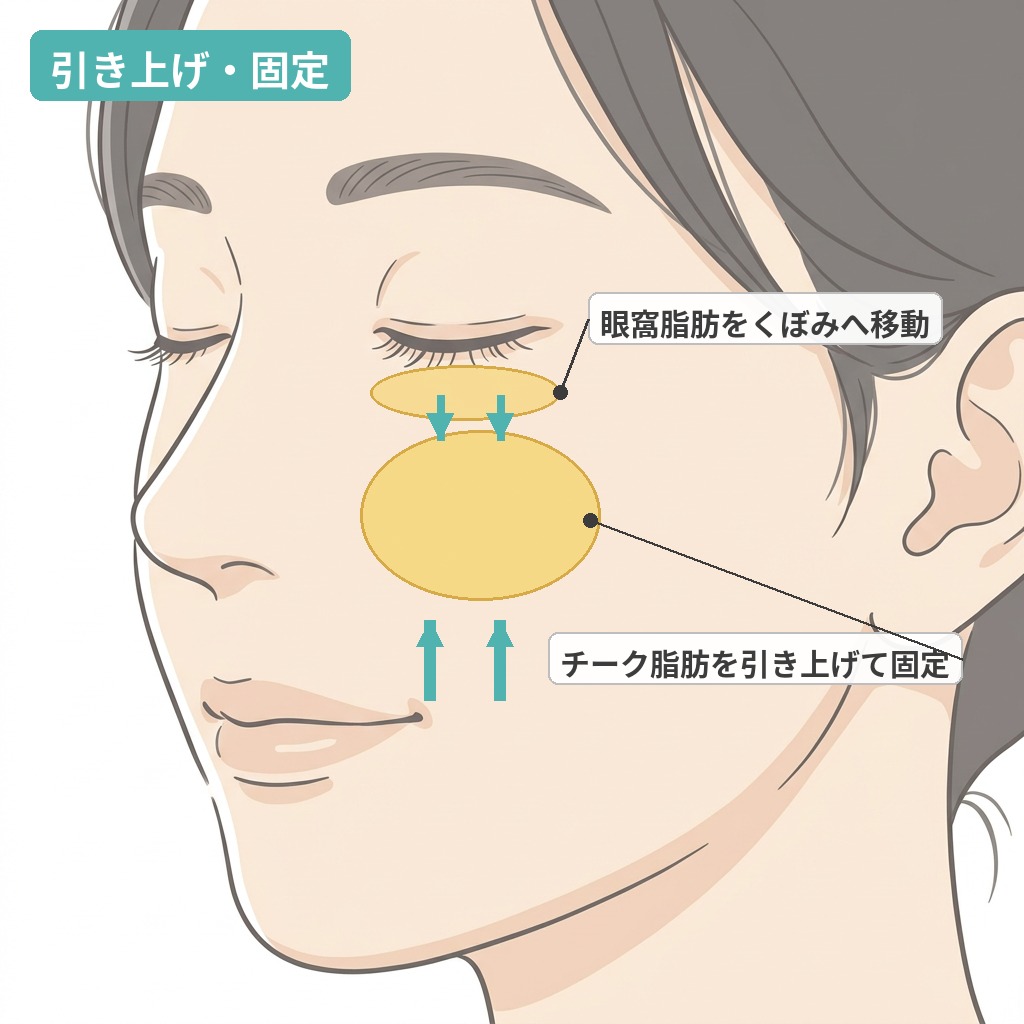 引き上げ・固定：眼窩脂肪の移動とメーラーファットの引き上げ