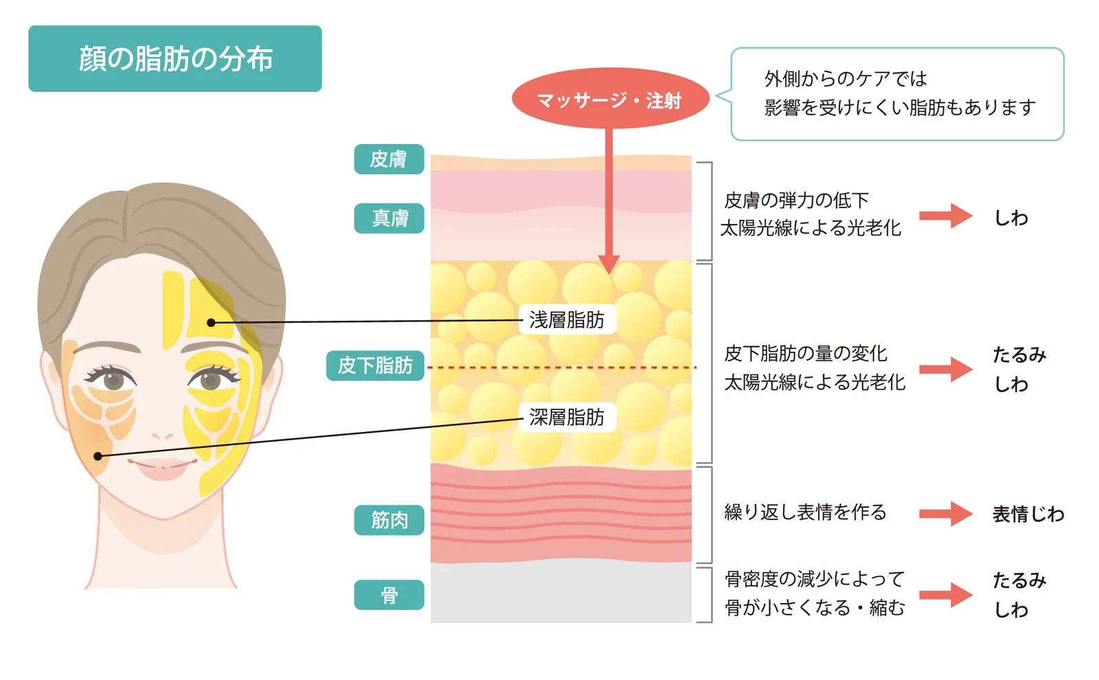 皮膚・真皮・浅層脂肪・深層脂肪・筋肉・骨の層と、それぞれの変化がたるみやしわにつながることを示した顔の脂肪の分布図(Leap beauty clinic)