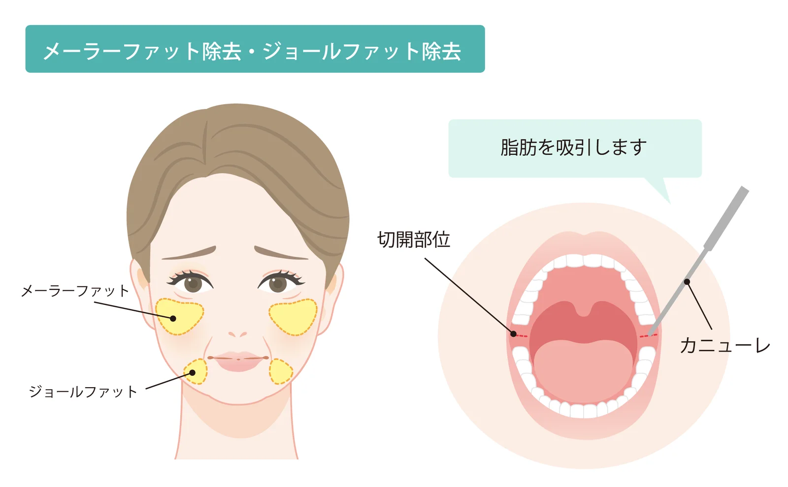 メーラーファットとジョールファットの位置を顔のイラストに示し、口の中の切開部位からカニューレで脂肪を吸引する様子を描いたメーラーファット除去・ジョールファット除去の図(Leap beauty clinic)
